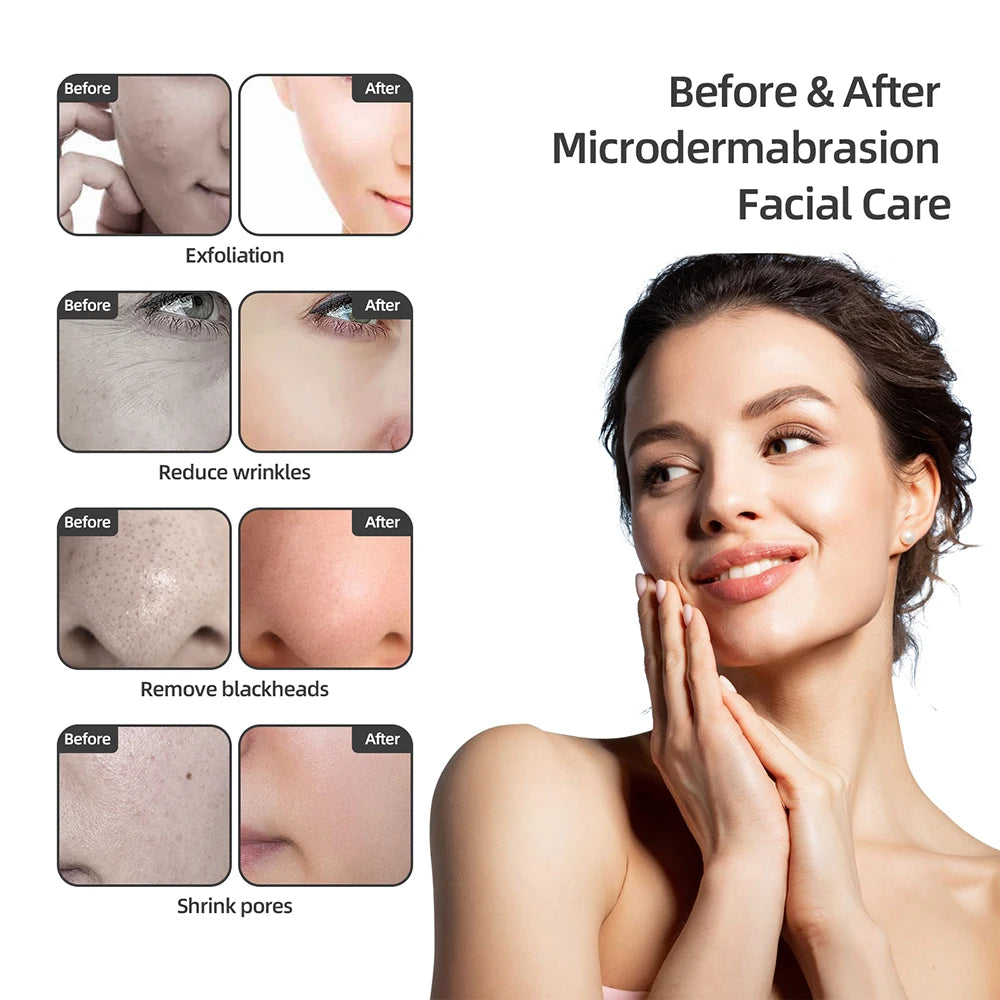 Foreverlily Spa Facial Peeling Deep Cleansing Pore Device